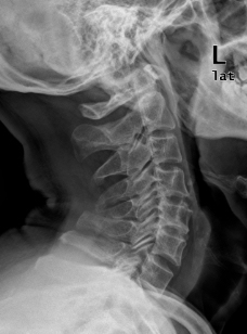 颈侧位 骨科 医生 x光图片