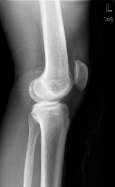 膝盖 x光图片