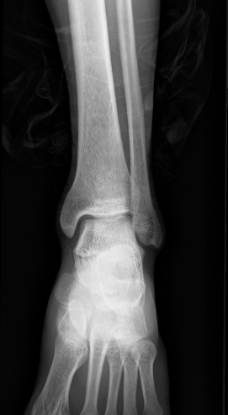 裸脚 骨科 医生 x光图片
