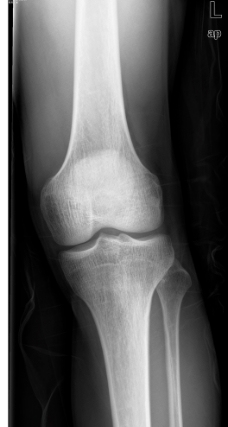 膝盖 骨科 医生 x光图片